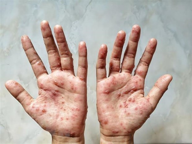 Các ban đỏ nổi trên tay một bệnh nhân mắc đậu mùa khỉ. (Ảnh: Shutterstock/TTXVN) Jordan phát hiện trường hợp đầu tiên mắc bệnh đậu mùa khỉ ảnh 1
