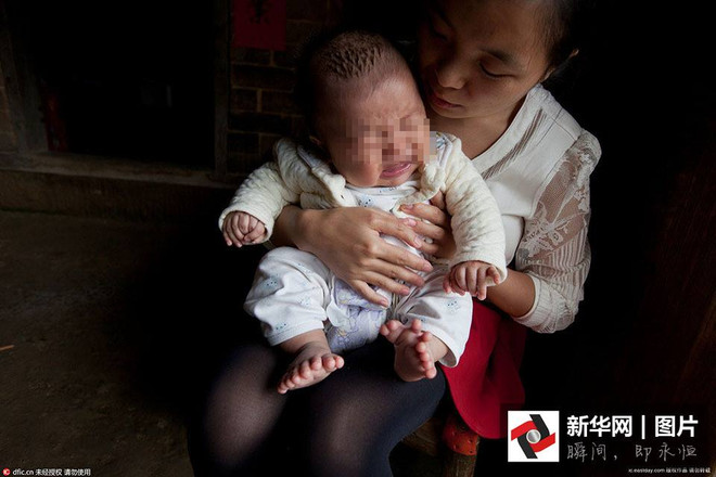 Bé trai Trung Quốc chào đời với 31 ngón tay, ngón chân ảnh 3