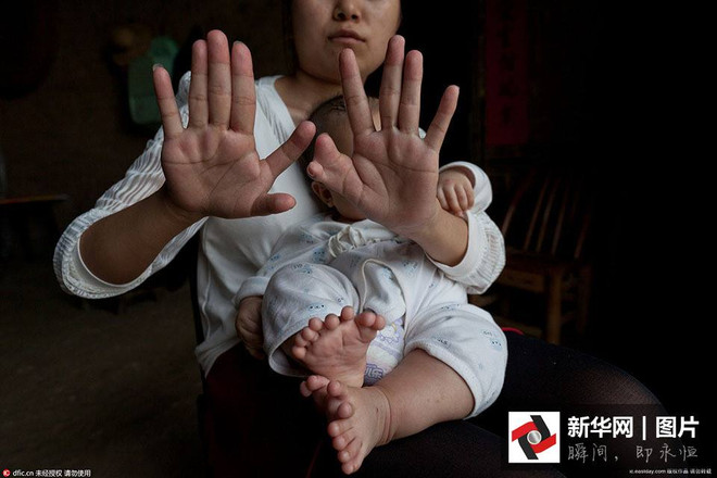 Bé trai Trung Quốc chào đời với 31 ngón tay, ngón chân ảnh 2
