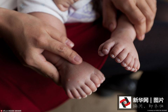 Bé trai Trung Quốc chào đời với 31 ngón tay, ngón chân ảnh 4