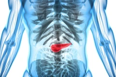 Cấp cứu kịp thời cô gái đứt rời đuôi tụy do tai nạn giao thông