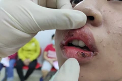 Làm đẹp bằng son giá rẻ không rõ nguồn gốc, môi thiếu nữ sưng tấy mủ