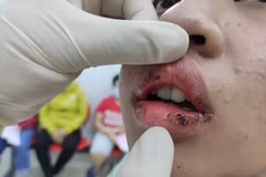 Làm đẹp bằng son giá rẻ không rõ nguồn gốc, môi thiếu nữ sưng tấy mủ