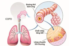 Ghép tế bào gốc tự thân để điều trị bệnh phổi tắc nghẽn mạn tính