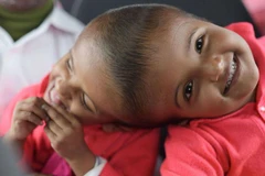 Hai bé song sinh dính liền đầu, ảnh chụp ngày 5/1/2019. (Nguồn: AFP)