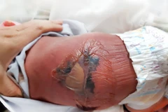 Lưng trẻ sơ sinh bị bỏng nặng, phồng rộp do sưởi ấm bằng than. (Ảnh: TTXVN phát)
