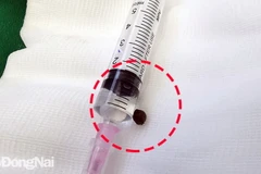 Dị vật là hạt tiêu được gắp ra khỏi đỉnh phổi bệnh nhân. (Nguồn: baodongnai.vn)