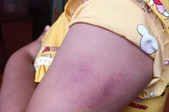 Em H.T.R với vết bầm tím ở tay. (Nguồn: laodong.vn)