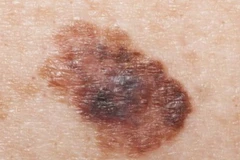 Một dấu hiệu của ung thư da. (Nguồn: BBC)