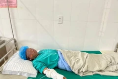 Bệnh nhân Lù A Chơ (sinh năm 1972) bị bỏng độ 1, đang điều trị tại Bệnh viện Đa khoa khu vực Nghĩa Lộ. (Ảnh: TTXVN phát)