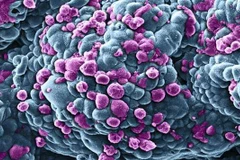 Các nhà khoa học Italy tìm ra cơ chế di căn ở bệnh ung thư vú