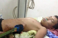 Cháu bé bị cây nứa đâm vào người. (Ảnh: Lan Anh/TTXVN)