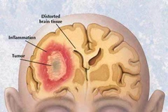 Ảnh minh họa. (Nguồn: huffingtonpost.com)