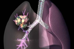 Ảnh minh họa. (Nguồn: clevelandclinic.org)