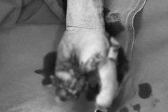 Bàn tay của bệnh nhân bị dập nát do điện thoại phát nổ. (Ảnh: PV/Vietnam+)