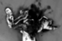 Bàn tay dập nát của bệnh nhân do điện thoại phát nổ trong khi sạc dự phòng. (Ảnh: PV/Vietnam+)