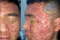 Bệnh nhân nhập viện với tình trạng nhiều mụn mủ, mụn bọc đầy mặt. (Ảnh: PV/Vietnam+)