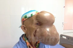 Bà Triệu Mùi Chài với khối u khổng lồ trên mặt. (Ảnh:T.G/Vietnam+)