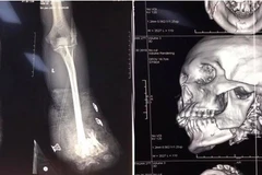 Hình ảnh chụp X-quang về tai nạn thương tích của một bệnh nhân bị tai nạn do pháo nổ tại Bệnh viện Trung ương Quân đội 108. (Ảnh: PV/Vietnam+)