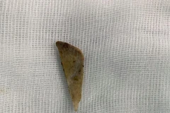 Mảnh xương được các bác sỹ lấy ra từ trong ruột của bệnh nhân. (Ảnh: PV/Vietnam+)