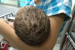 Bé trai nhiễm độc da toàn thân do mẹ tắm lá chữa thủy đậu 