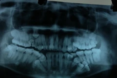 Phim chụp hình ảnh những răng thừa của bệnh nhân ở cả hai hàm. (Ảnh: PV/Vietnam+)