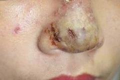 Mũi bệnh nhân tiết dịch, hình thành nhiều ổ mủ trên mũi. (Ảnh: PV/Vietnam+) 