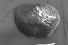 Khối u gan của bệnh nhân được lấy ra khỏi cơ thể của bệnh nhân. (Ảnh: Bệnh viện cung cấp)