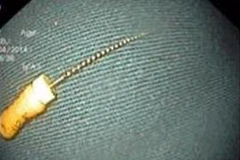 Cây kim sắc nhọn đã được lấy ra khỏi dạ dày cháu bé. (Ảnh: Bệnh viện Nhi Trung ương cung cấp)