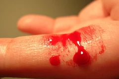 Ảnh minh họa. (Nguồn: reference.medscape.com)