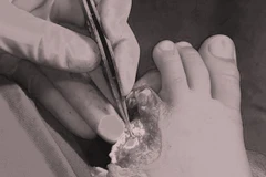 Ngón chân bị đứt rời của bé. (Ảnh: PV/Vietnam+)