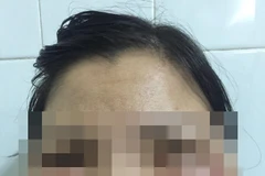 Khuân mặt biến dạng của bệnh nhân. (Ảnh: Bác sỹ cung cấp)