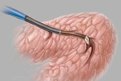 Phương pháp nội soi trong chẩn đoán và điều trị bệnh lý tuyến nước bọt.