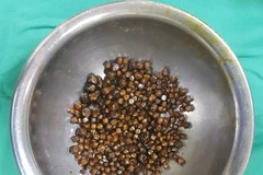 Hàng trăm viên sỏi được lấy ra từ túi mật của bệnh nhân. (Ảnh: PV/Vietnam+)