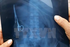 Hình ảnh chụp X-quang chiếc kéo trong ổ bụng của ông Nhật. (Ảnh: Bùi Đức Hiếu/TTXVN)