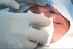 Một phụ nữ bị mù mắt sau khi tiêm chất làm đầy nâng mũi 