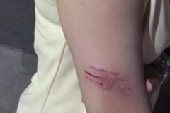 Người dân bị khỉ tấn công tại Bình Dương. (Ảnh: TTXVN phát)