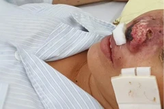 Bệnh truyền nhiễm dễ gây tử vong Whitmore tái xuất hiện ở Việt Nam