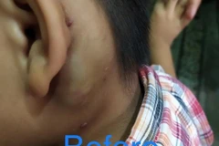 Hình ảnh khối u trước can thiệp. (Ảnh: TTXVN phát)