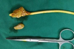 Bệnh viện Thanh Nhàn trả lời về vụ quên dụng cụ trong cơ thể bệnh nhân