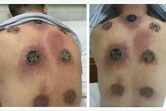 Bảy vết thương khủng khiếp do giác hơi. (Nguồn: shanghaiist.com)