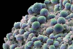 Tế bào ung thư tuyến tiền liệt. (Nguồn: images.google.com)