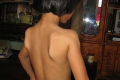 Bệnh nhân xơ hóa cơ delta. (Nguồn: Internet)