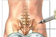 Hình minh họa một tủy xương. (Nguồn: Internet)