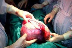 Các y, bác sỹ đang thực hiện ca phẫu thuật cắt bỏ khối u nặng 4,8kg. (Nguồn: baohagiang.vn)