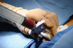 Lấy tủy sương. (Nguồn: Wikipedia)