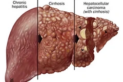 Nhật Bản phát hiện các ca đầu tiên nhiễm viêm gan E mãn tính