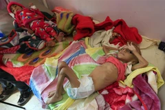 Trẻ em suy dinh dưỡng được điều trị tại bệnh viện ở Sanaa, Yemen ngày 6/10/2018. (Ảnh: AFP/TTXVN)