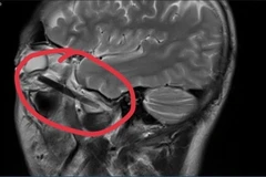 Hình ảnh dị vật trong mắt người đàn ông ở tỉnh Bình Dương. (Ảnh: TTXVN phát)