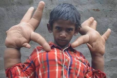 Cậu bé 8 tuổi người Ấn Độ bị xa lánh vì có đôi tay "khổng lồ"